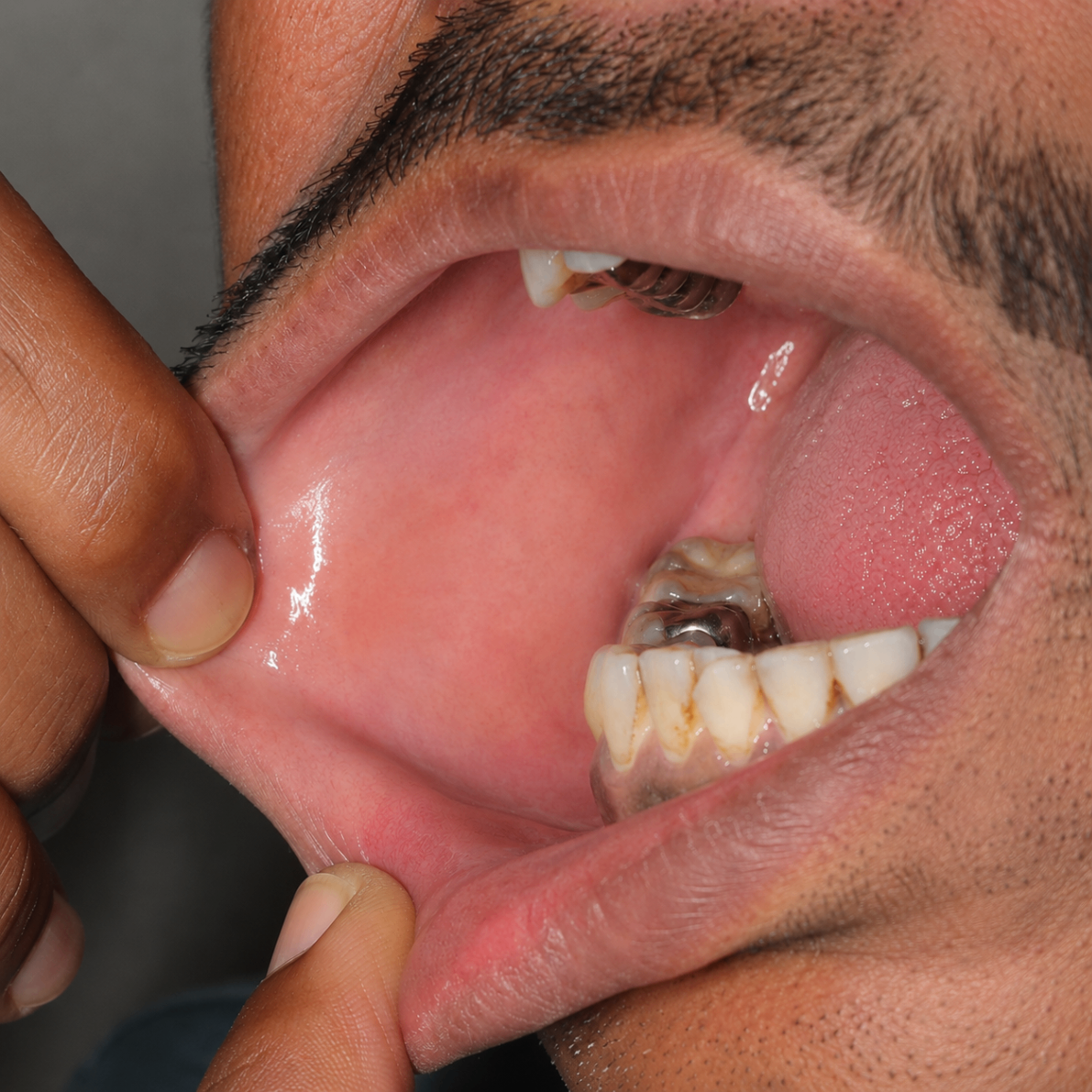 After treatment follow-up view showing improvement in oral lichen planus inside the cheek