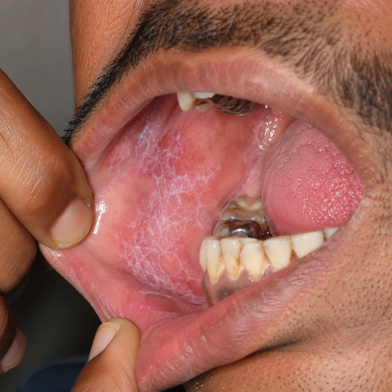 Before treatment view of oral lichen planus inside the cheek